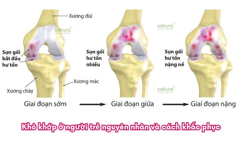 Khô khớp ở người trẻ nguyên nhân và cách khắc phục