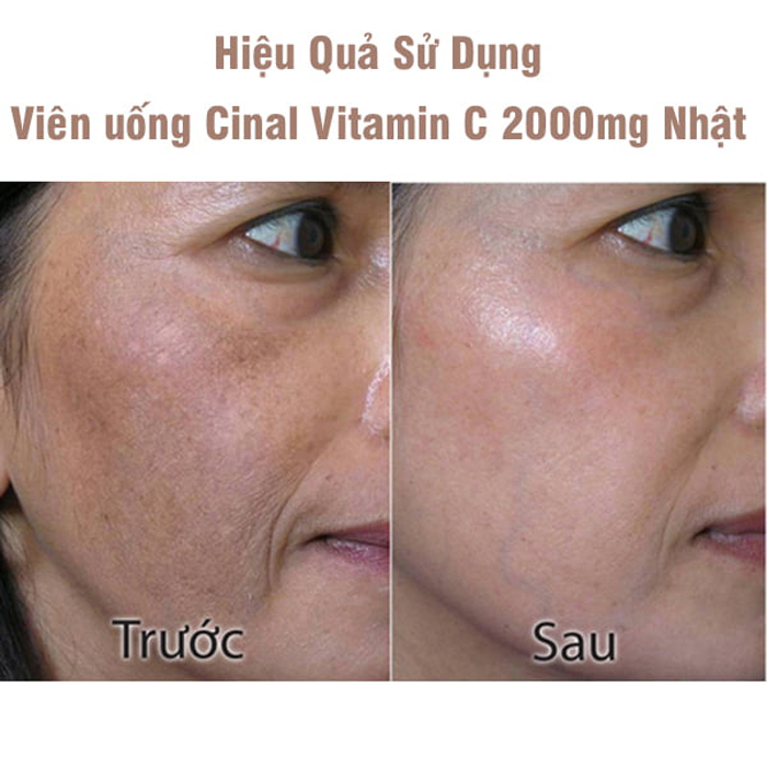 Viên Uống Vitamin C Hỗ Trợ Trắng Da, Mờ Nám Cinal C Nhật Bản