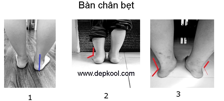 BÀN CHÂN BẸT - Mức độ tăng dần