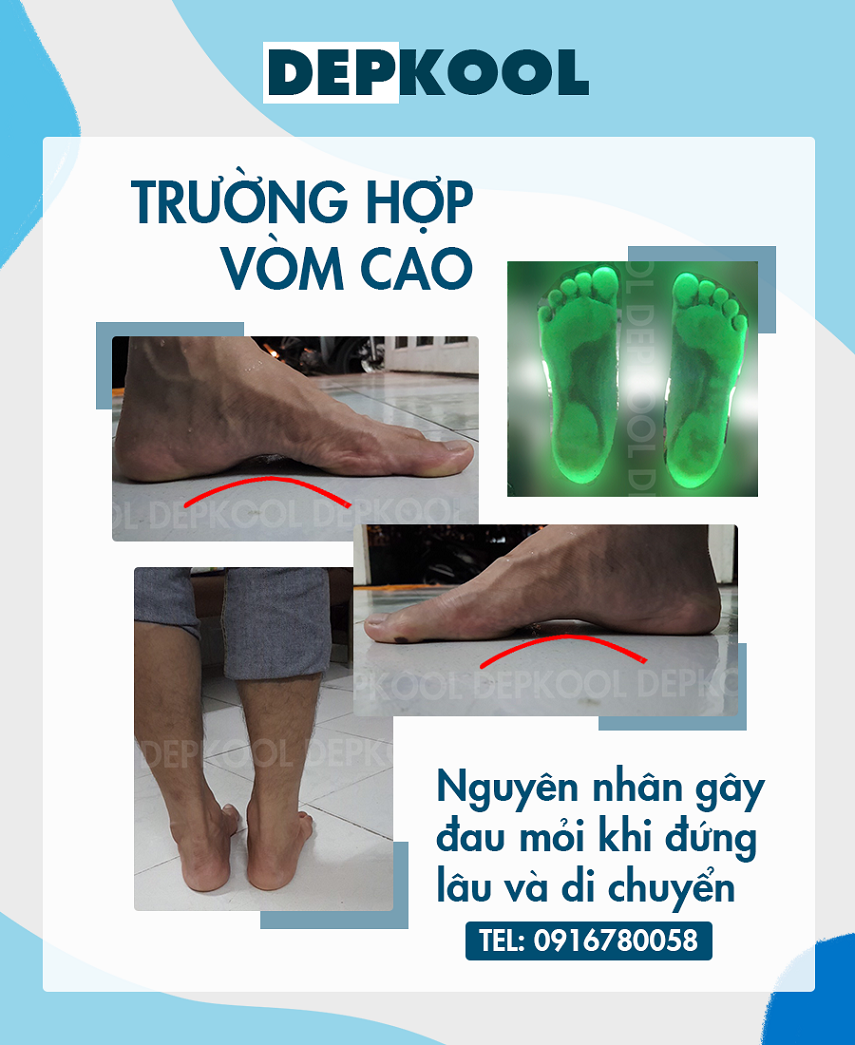 Bàn chân vòm cao (lõm cao)