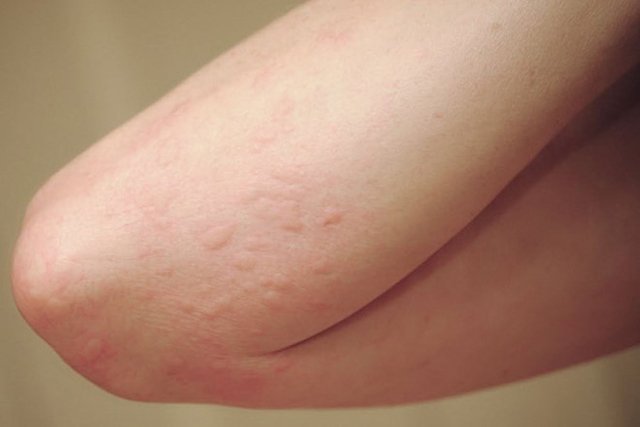 Dị ứng thời tiết bao lâu thì khỏi
