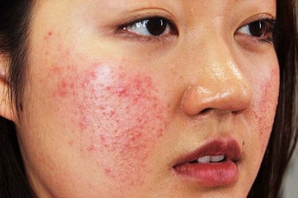 Dị ứng thời tiết bao lâu thì khỏi