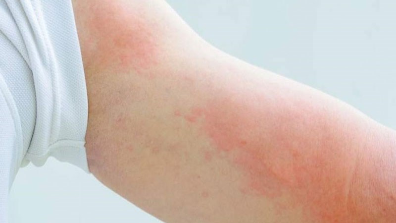 Dị ứng thời tiết bao lâu thì khỏi