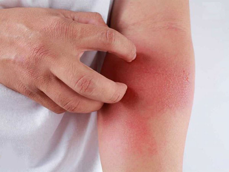 Mẹo chữa zona thần kinh tại nhà