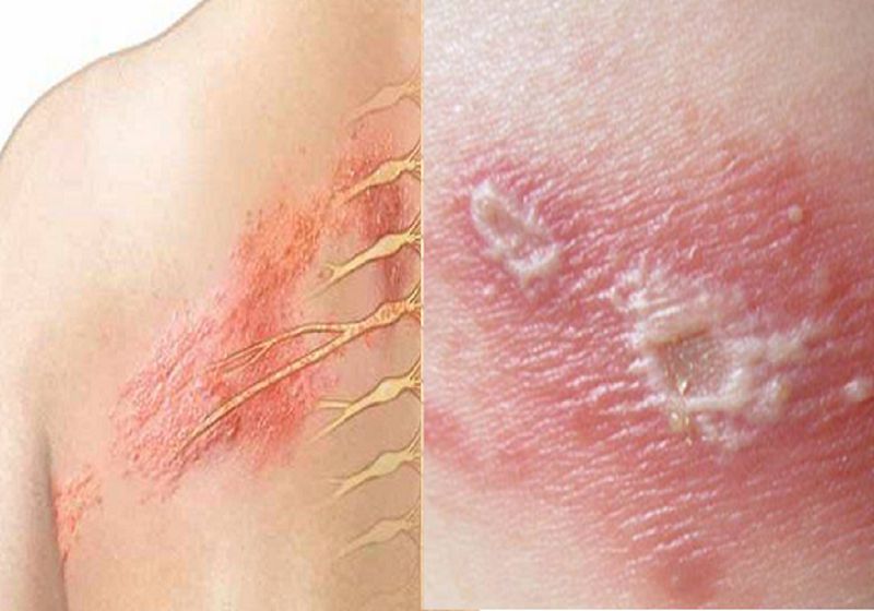 Mẹo chữa zona thần kinh tại nhà