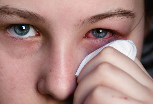 Chăm sóc bé bị đau mắt đỏ cha mẹ cần làm gì?