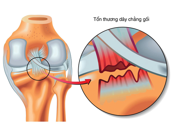 Đứt dây chằng gối có nguy hiểm không