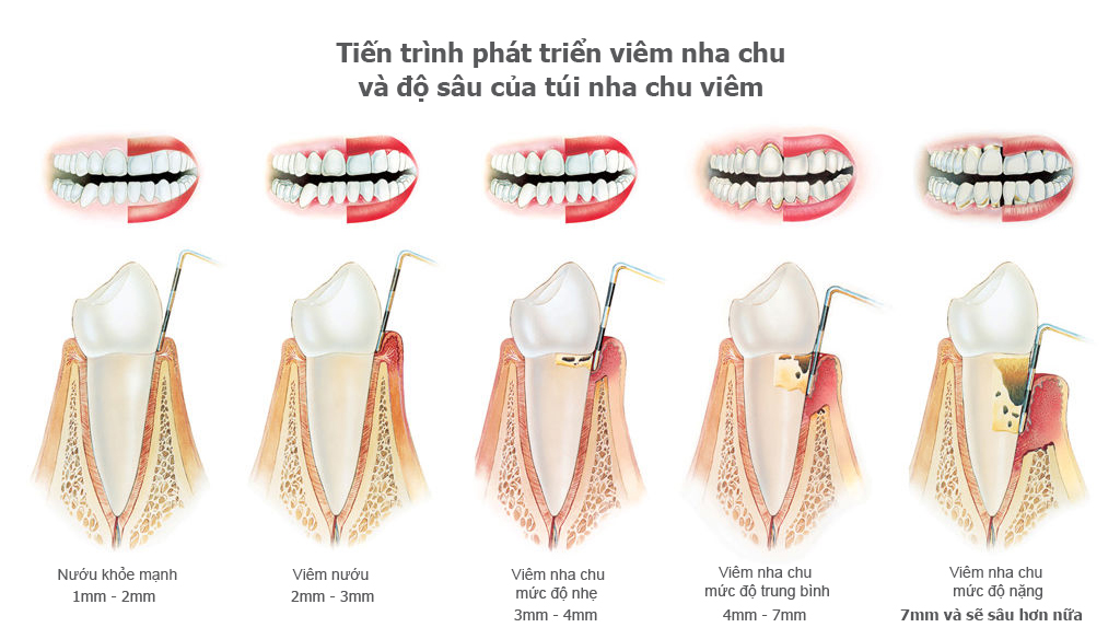 Nguyên nhân và cách phòng bệnh viêm nha chu