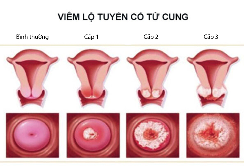 Bệnh viêm lộ tuyến cổ tử cung có nguy hiểm không?