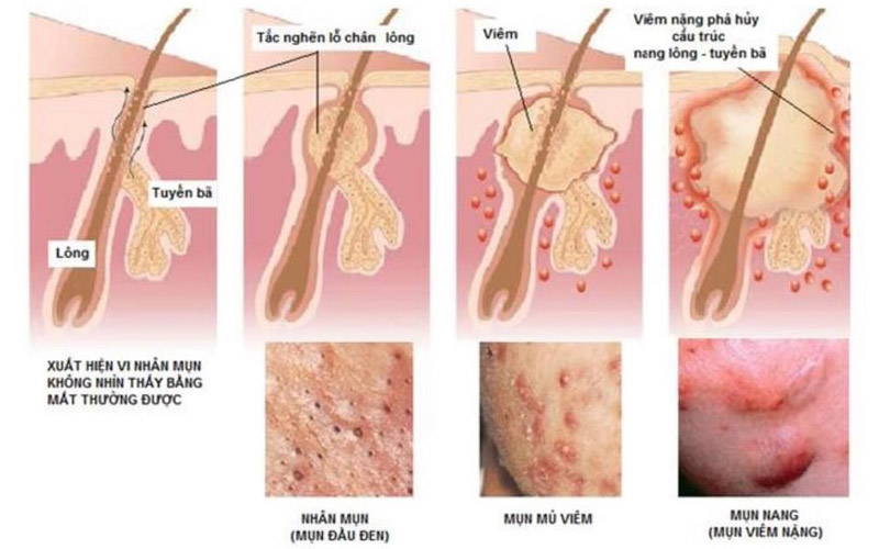 Hình ảnh viêm nang lông