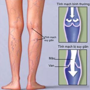 bệnh giãn tĩnh mạch chân