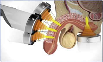 Liệu Pháp Sóng Xung Kích Trong<br> Điều Trị Rối Loạn Cương Dương<br> và Bệnh Peyronie