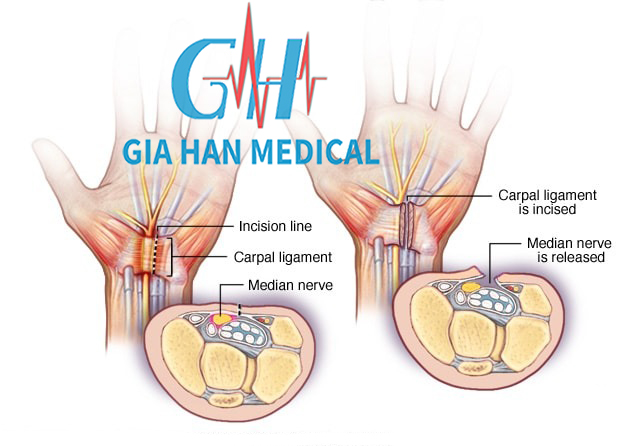 Siêu âm trị liệu trong điều trị <br>hội chứng ống cổ tay