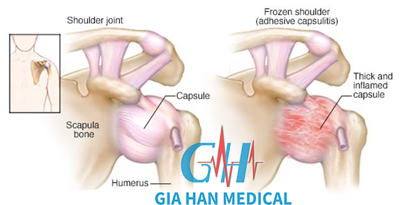 Siêu âm trị liệu trong điều trị cứng <br>khớp vai do viêm dính bao khớp vai
