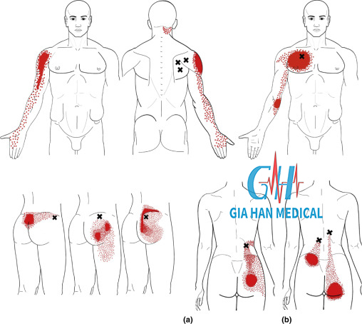 Siêu âm trị liệu trong điều trị <br>hội chứng đau cân cơ