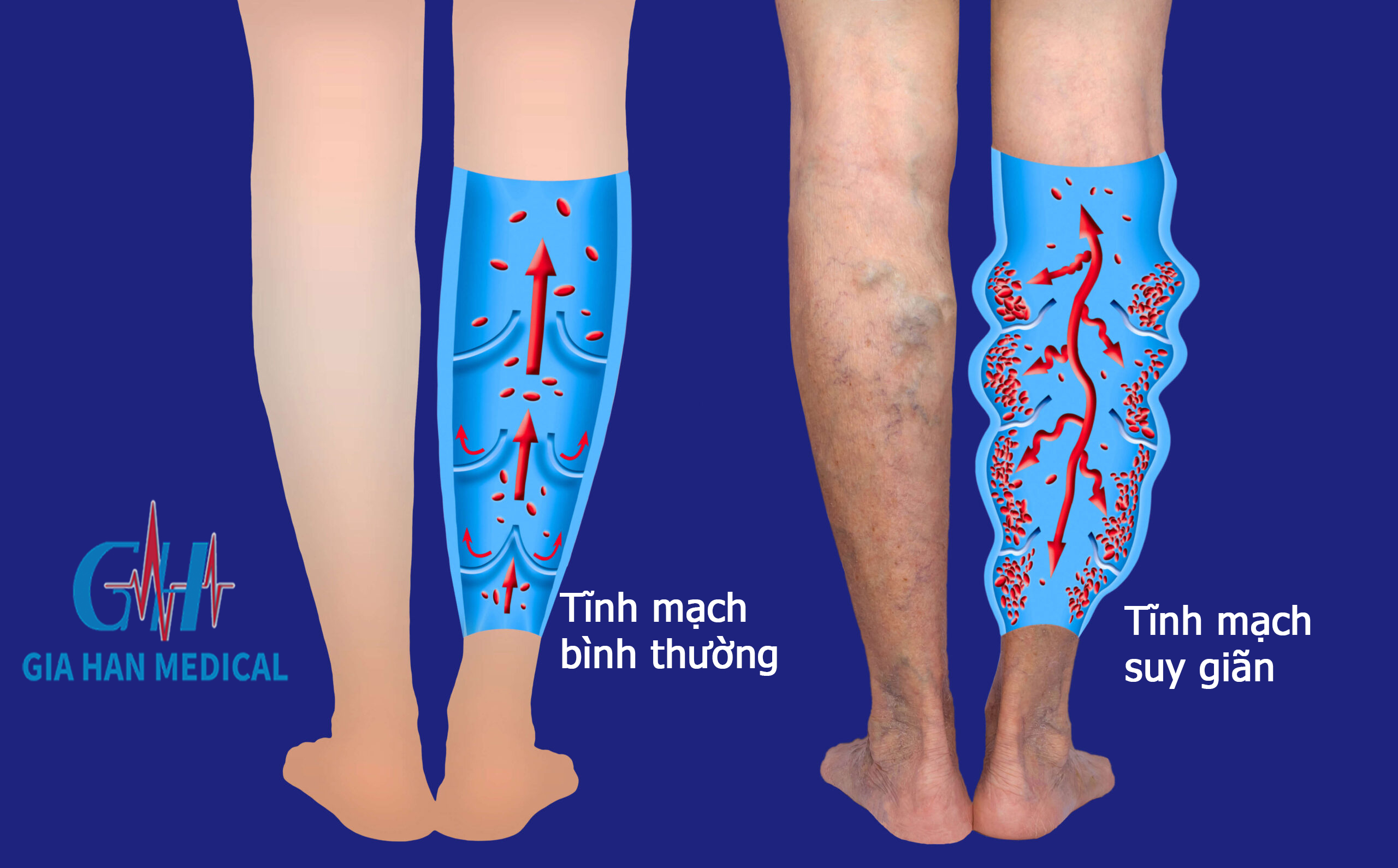 Nguyên nhân gây ra bệnh suy giãn tĩnh mạch?