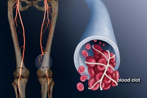 Chứng huyết khối là gì ?