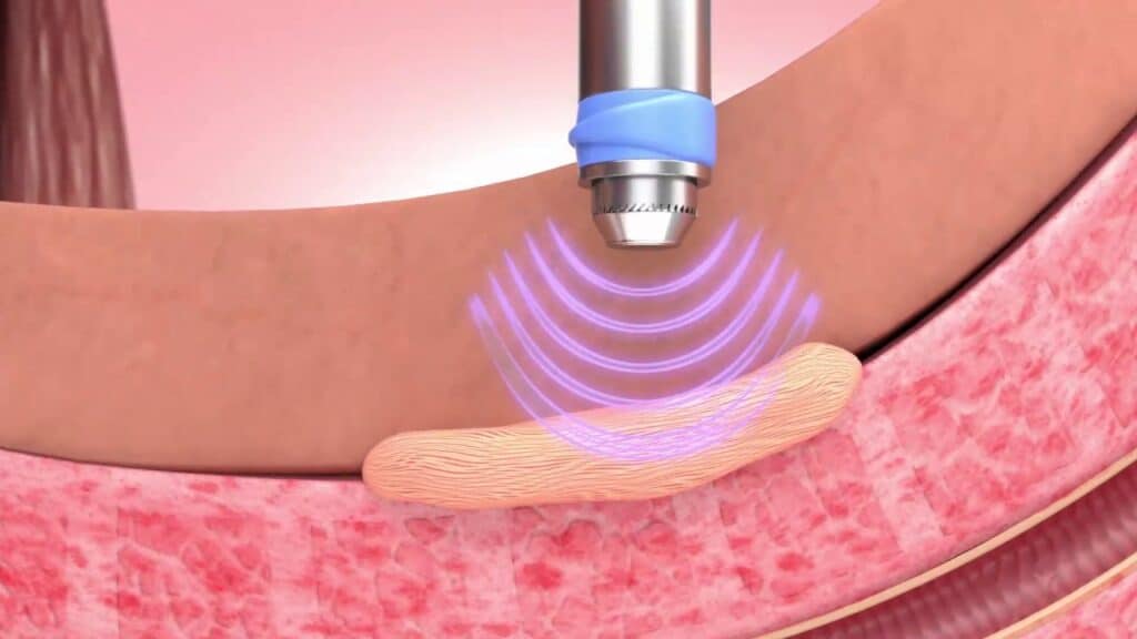 Điều Trị Bệnh xơ hóa hang vật<br> Peyronie bằng sóng xung kích