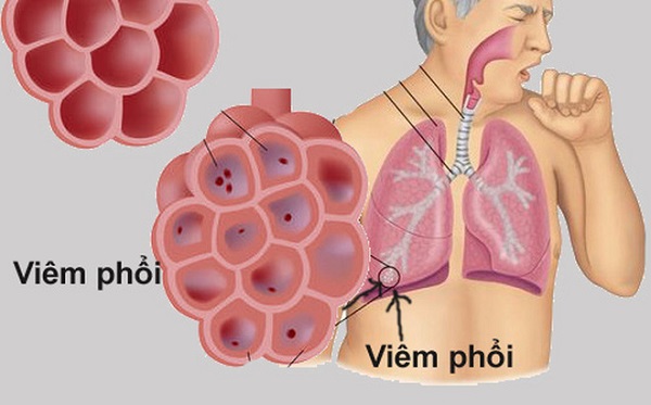 Bụi mịn ảnh hưởng trực tiếp đến các bệnh về hô hấp