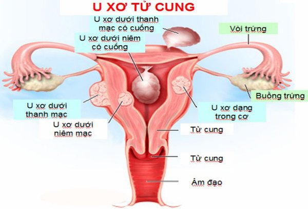 bien-chung-nguy-hiem-cua-benh-u-xo-tu-cung-va-cach-de-phong