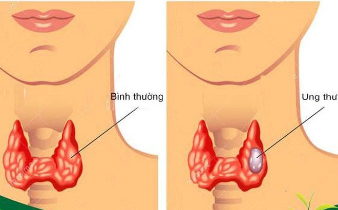 3 dấu hiệu bệnh ung thư tuyến giáp bạn nên biết để phòng bệnh tật