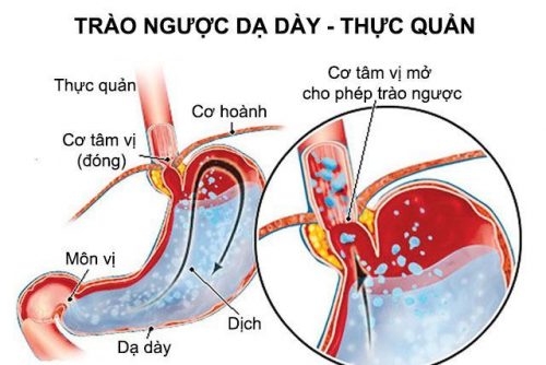 CHỮA KHỎI BỆNH TRÀO NGƯỢC DẠ DÀY | PHÒNG KHÁM BỆNH ĐÔNG Y NGUYỄN HỮU HÁCH