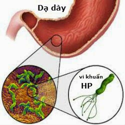 Khuẩn H.P là gì? Tác dụng của Đông Y trong chữa bệnh dạ dày khuẩn HP