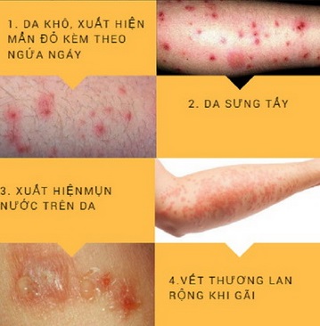 Bệnh về da hay gặp vào mùa hè