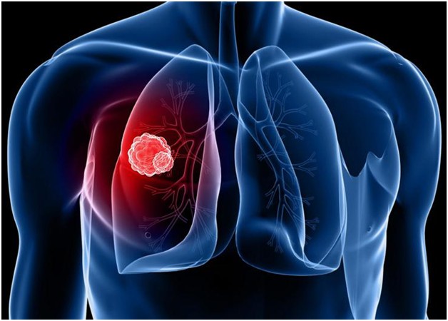 Phân loại bệnh ung thư phổi