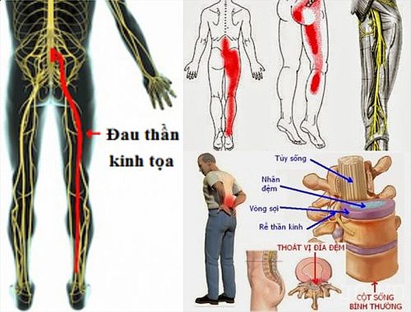 Châm cứu trị bệnh đau dây thần kinh tọa như thế nào?