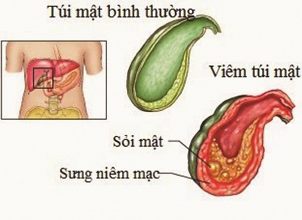 Chè viêm mật sỏi mật