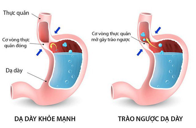 Biến chứng nguy hiểm đến từ bệnh trào ngược dạ dày