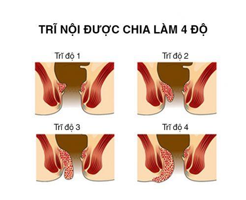 Đông y đẩy lùi bệnh trĩ nội, trĩ ngoại hiệu quả