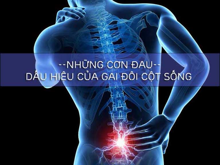 Gai đôi cột sống