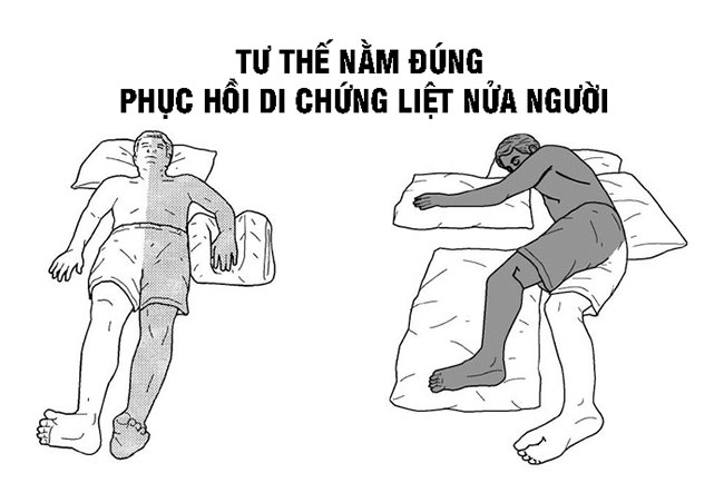 Liệt nửa người