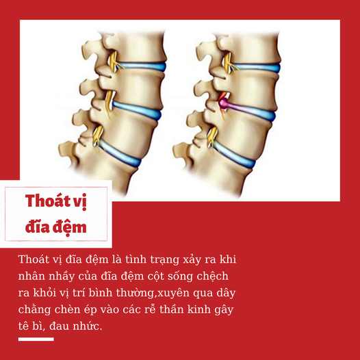 Đông Y Chữa Thoát Vị Đĩa Đệm | NHÀ THUỐC ĐÔNG Y - NỔI TIẾNG