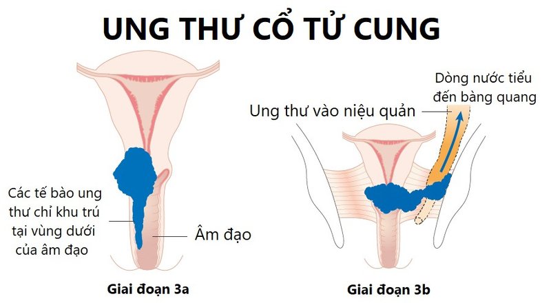 ung-thu-co-tu-cung-giai-doan-2-nen-lam-gi