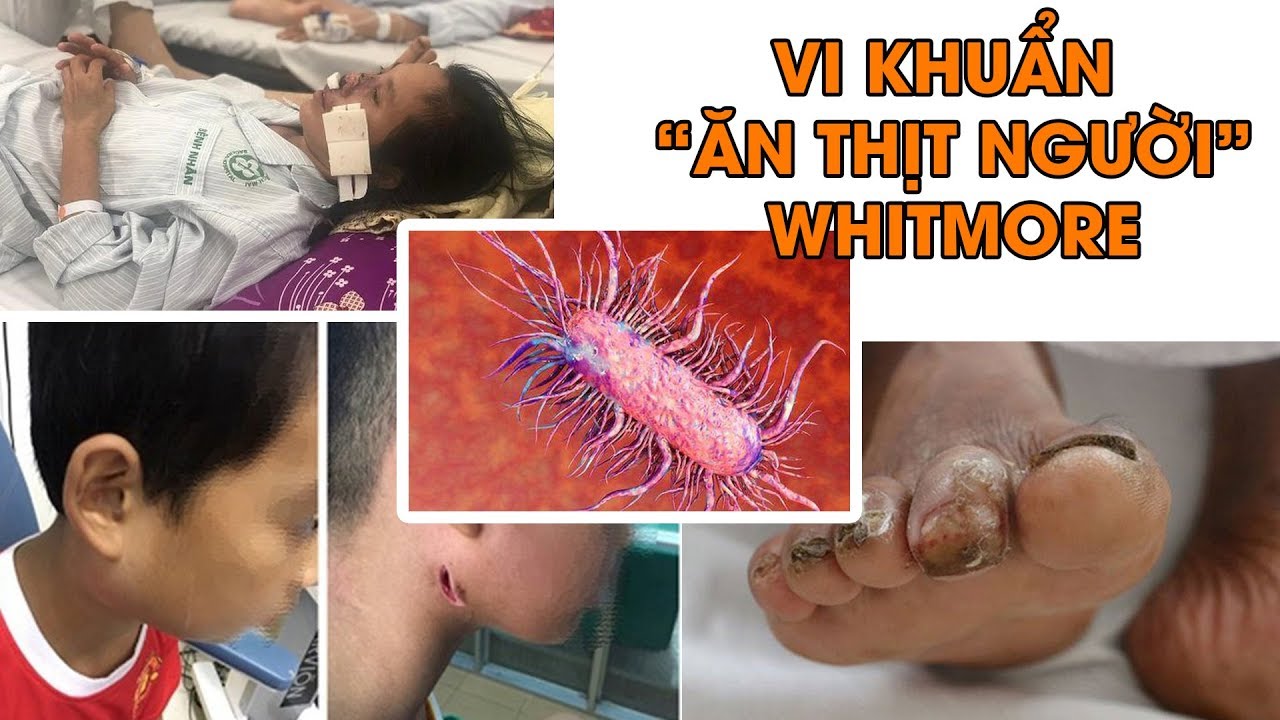 Cảnh báo vi khuẩn ăn thịt người Whitmore