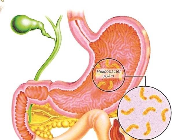 Bệnh dạ dày không chữa sau này sẽ nguy hiểm như thế nào?