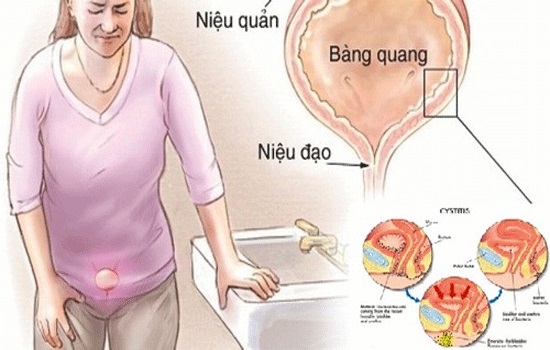 Phụ nữ lớn tuổi bị đi tiểu rắt, rát, ra máu, thiếu máu thì nên làm thế nào?