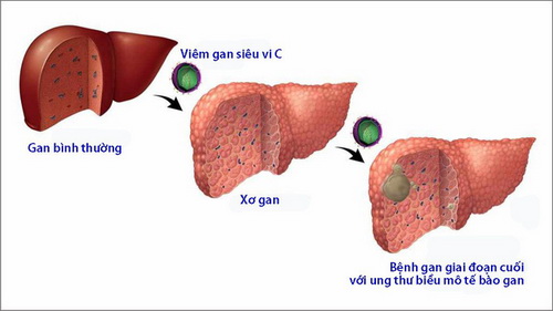 Đông y chữa bệnh viêm gan mạn tính