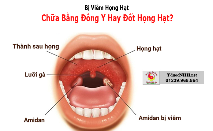 Bị viêm họng hạc đông y điều trị hay đốt họng hạc?