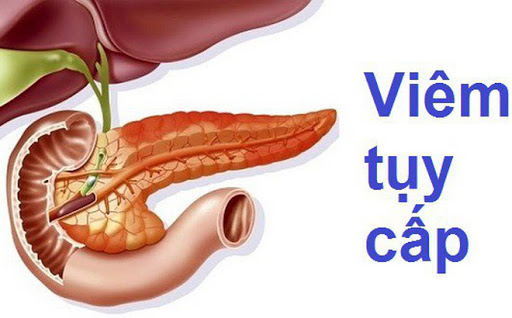 Một số điều cần biết về bệnh Viêm tụy cấp