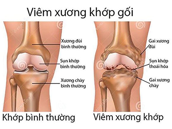 Bệnh viêm khớp nguyên nhân và hướng điều trị