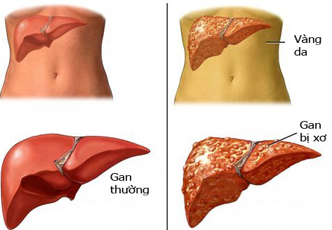 Xơ gan cổ trướng