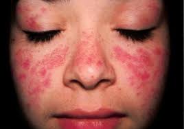 ban-do-lupus-nen-hay-khong-nen-dieu-tri