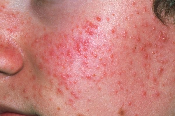 corticosteroid-co-the-gay-trung-ca-khong