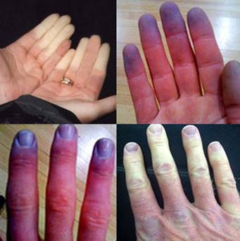 hoi-chung-raynaud