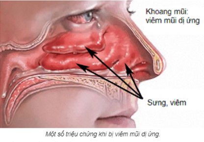 dieu-can-chu-y-khi-bi-viem-mui-di-ung