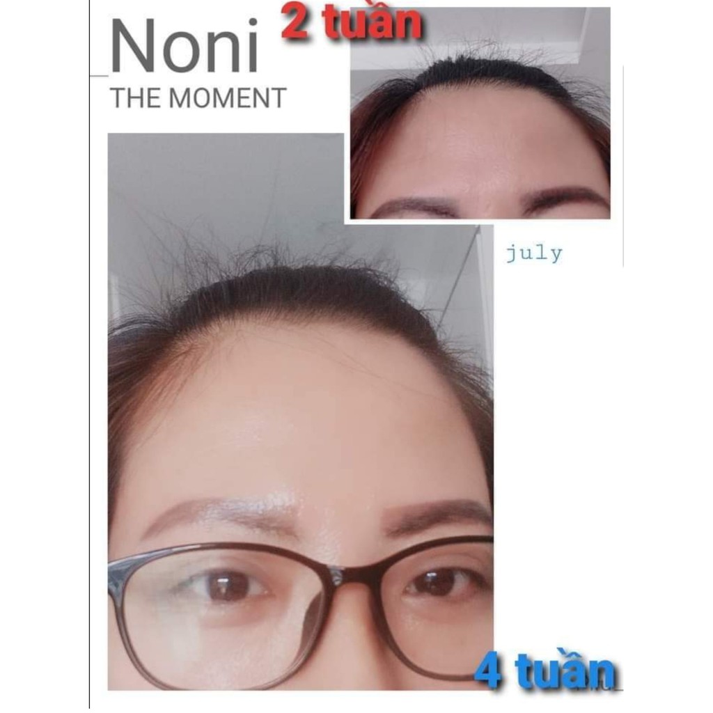 Gội xả Trái nhàu NoNi Anjo